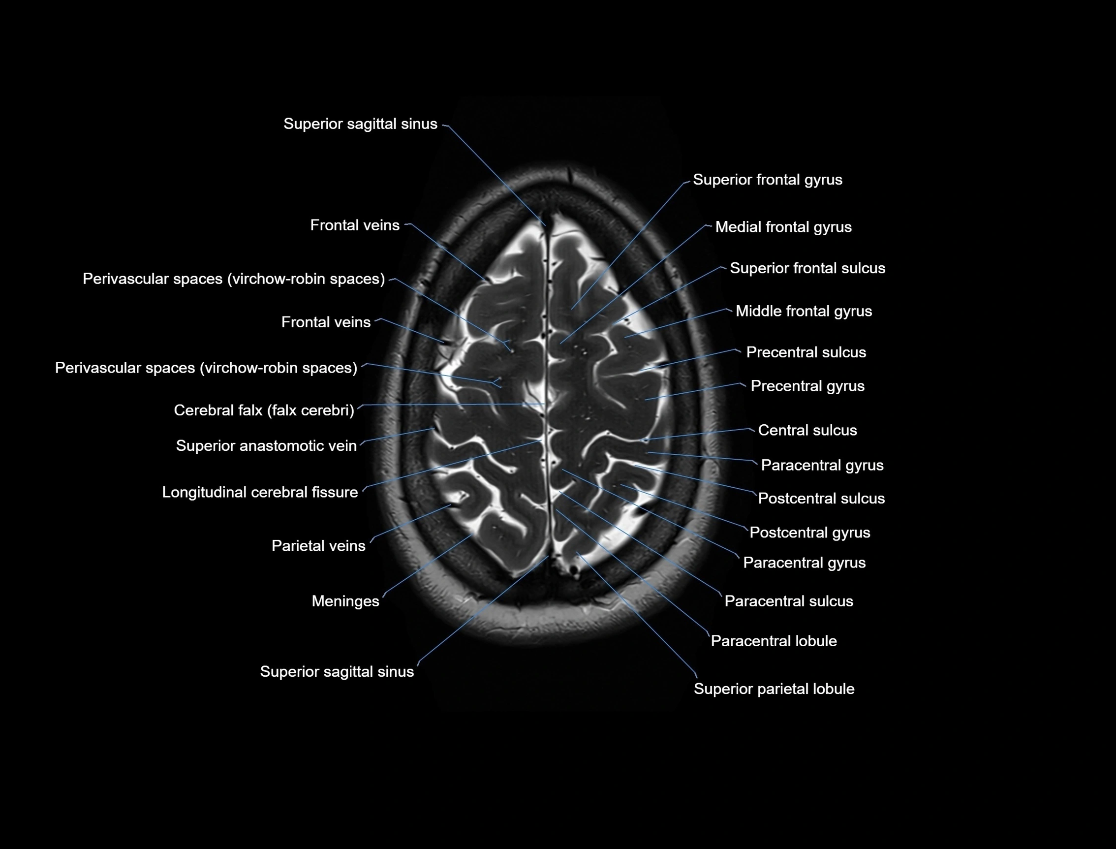 MRI Brain axial cross sectional radiology anatomy 3T image  -img-00001-00051.webp